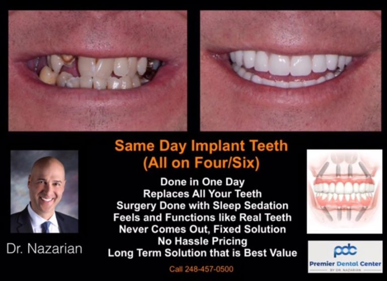 All On Four And Six Implants Dental Implant Dentist In Shelby Township Mi 